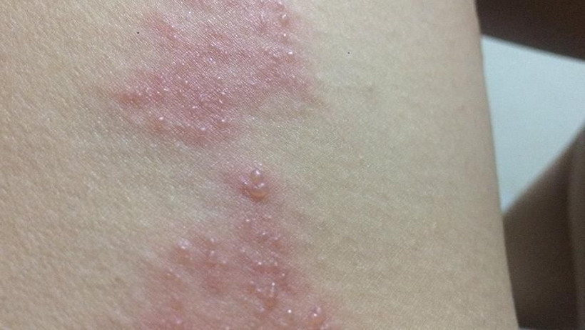 Zona belirtileri neler zonaya ne iyi gelir? - Resim: 2