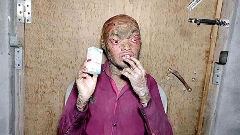 Hastalığına inanamayacaksınız! Her hafta deri değiştiriyor, çocuklar ondan kaçıyor - Resim: 4