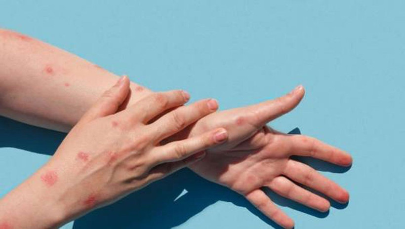 Kulaktan dolma bilgileri unutun! Maymun Çiçeği virüsü hakkında bilinmesi gerekenler - Resim: 2