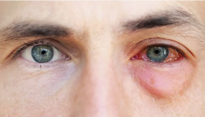 Gözde kaşıntıya dikkat! Bu hastalığın belirtisi olabilir... - Resim: 1