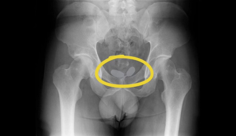 Biri cinsel organına, diğeri anüsüne uyuşturucu gizlemiş! Uyuşturucu kaçakçısı kadın ile erkeğin akılalmaz oyunu - Resim: 4