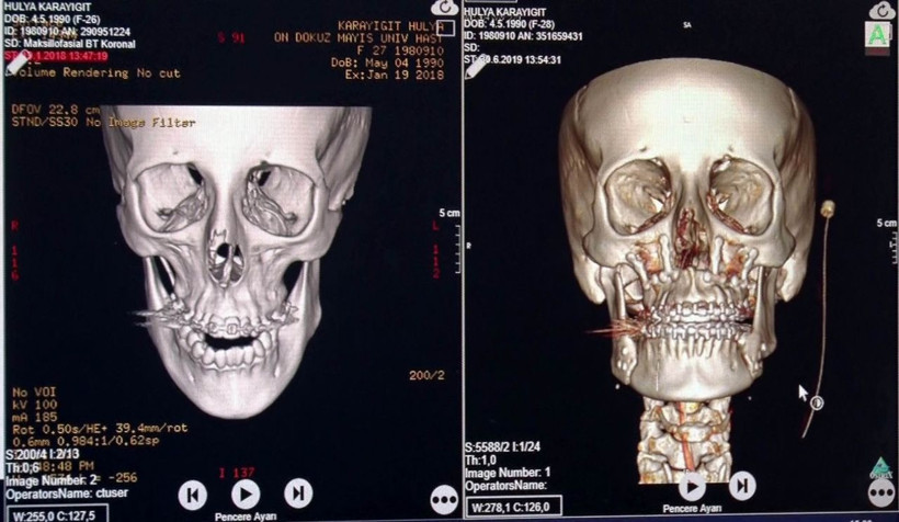 Samsun'da çene ameliyatı olan Hülya Karayiğit hem güzelliğine hem de sağlığına kavuştu - Resim: 1