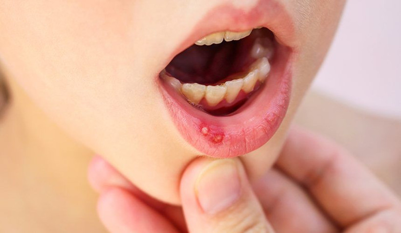 Ağızdaki aft nasıl geçer doğal yöntemler neler? - Resim: 3