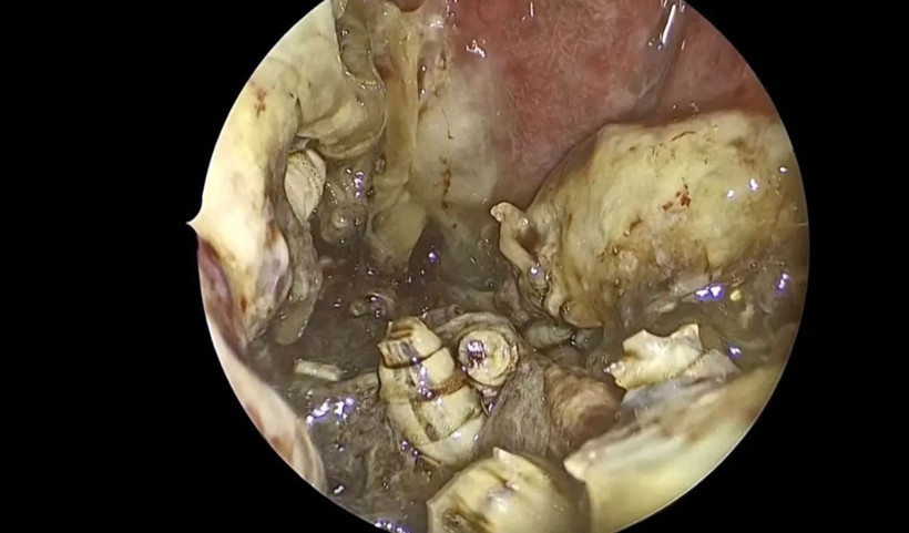 Doktorlar inanamadı! Burnundan 150 canlı kurtçuk çıkarıldı! - Resim: 4