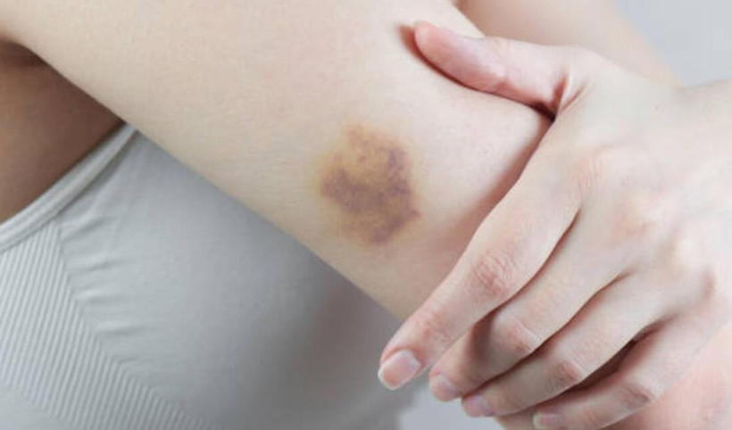 Vücudumuzdaki morluklardan doğal yollarla kurtulabilirsiniz - Resim: 2