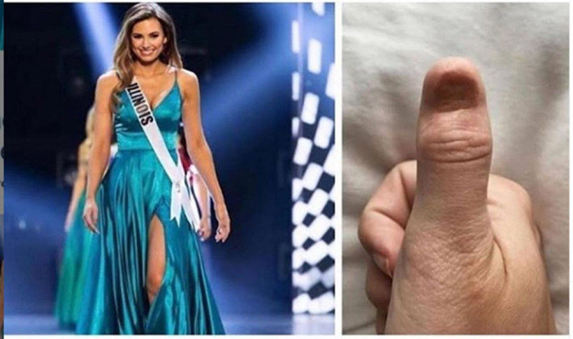 Şans eseri öğrenmişti Ünlü model kanseri böyle atlattı - Resim: 2