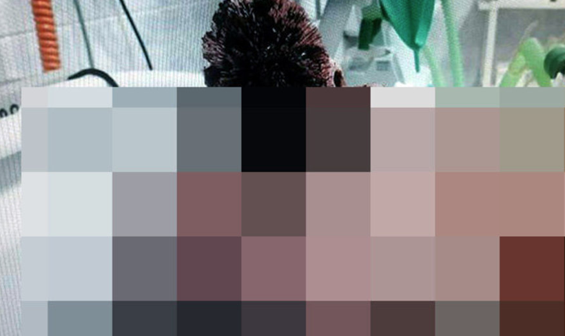 Tuvalet fırçası gözüne saplandı akıllara durgunluk veren olay! - Resim: 4