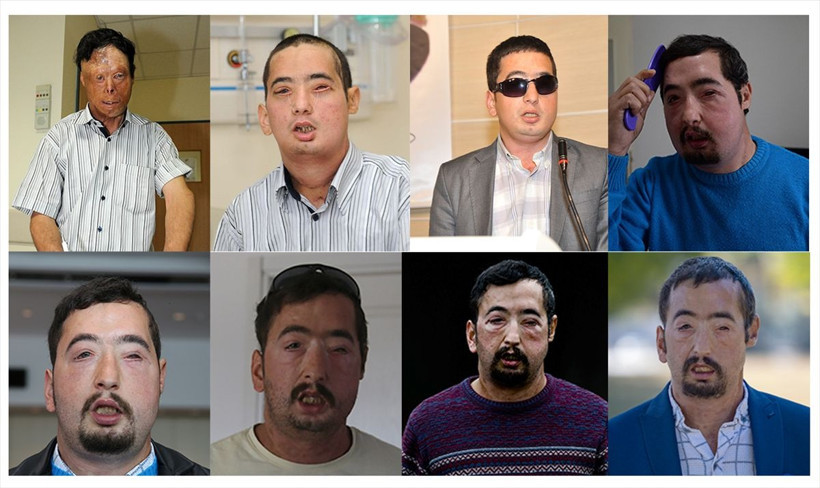 Türkiye'de ilk yüz nakli yapılan isimlerdi! Uğur Acar ve Turan Çolak'ın 10 yıl sonraki haline bakın - Resim: 4