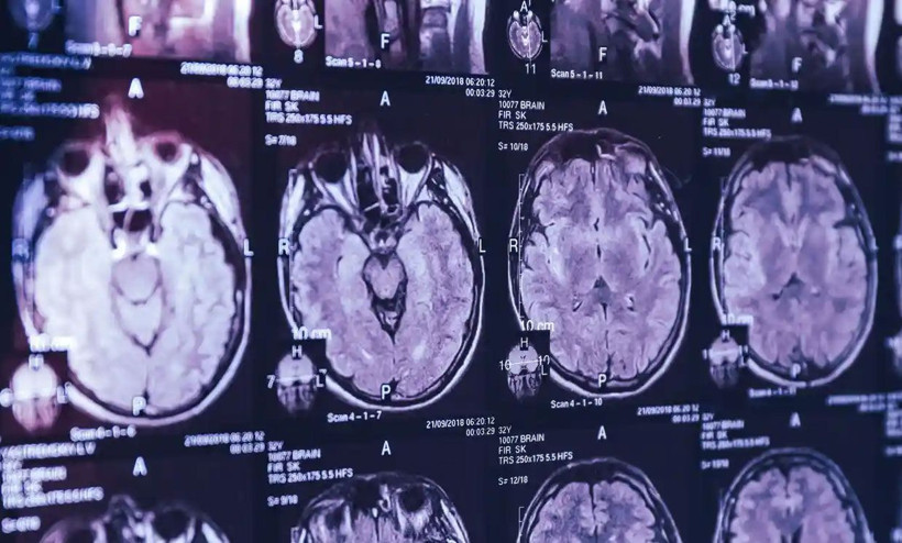 Korona salgını bitmeden yeni salgın başladı! 'Deli dana'ya benzeyen gizemli beyin hastalığı paniği - Resim: 1