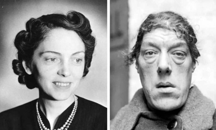 Yakalandığı hastalık sonrası bir anda dünyanın en çirkin kadını oldu - Resim: 2