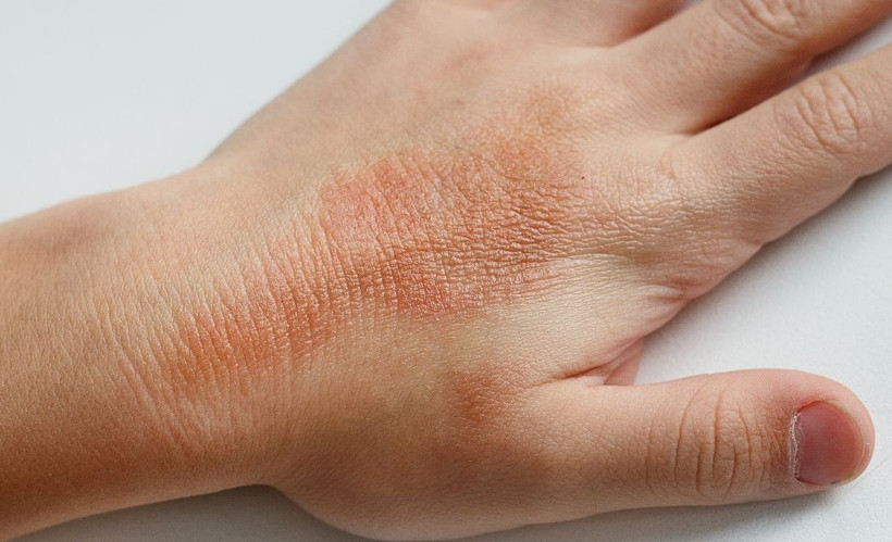 Egzaması olan kişiler dikkat! İşte doğal yoldan egzamadan kurtulma yöntemleri - Resim: 1