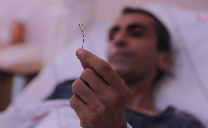 Doktor bile şok oldu bağırsaktan çıkana bakın - Resim: 2