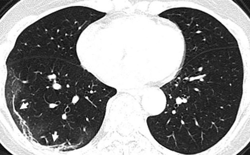 Koronavirüsünün akciğerlere verdiği zarar böyle görüntülendi - Resim: 1