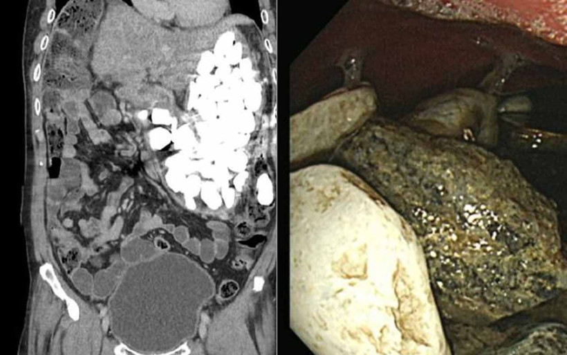 Midesinden çıkanı duyunca şoke olacaksınız! Tam 2 kilo - Resim: 3