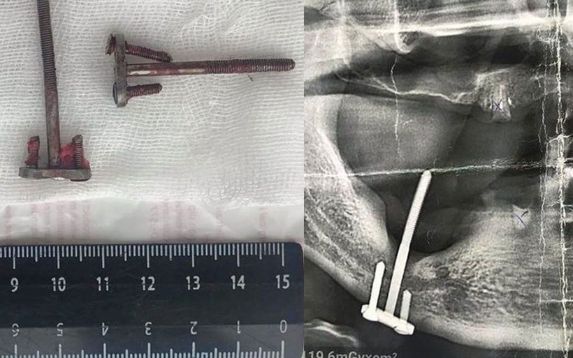 İmplant yerine sanayi tipi vida takmışlar! 28 yıl sonra öğrendi - Resim: 1