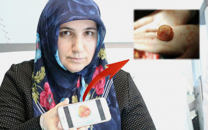 Kalbinden 6 santimetre çapında kitle çıkarıldı - Resim: 1