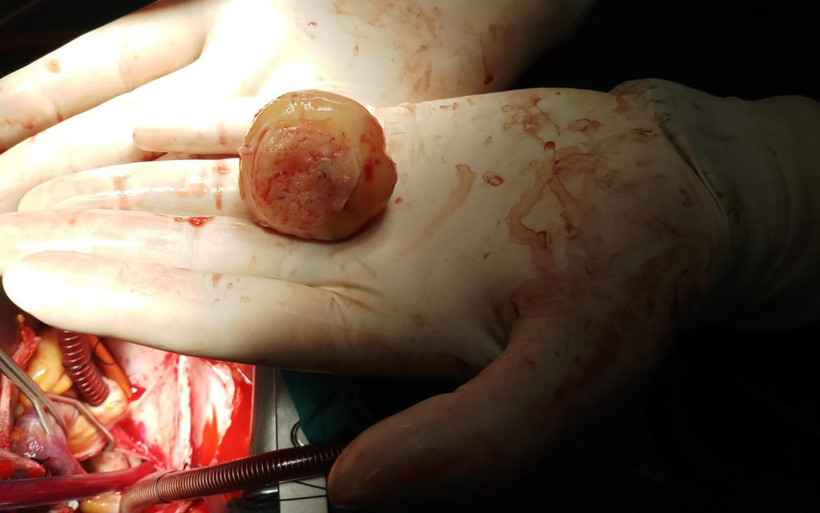 Kalbinden 6 santimetre çapında kitle çıkarıldı - Resim: 3