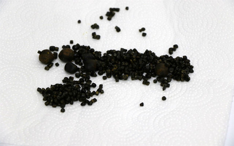 Yaşlı kadının safra kesesinden 450 tane taş çıktı - Resim: 1