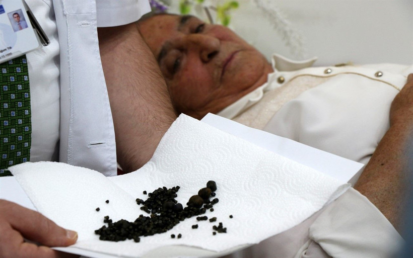 Yaşlı kadının safra kesesinden 450 tane taş çıktı - Resim: 2