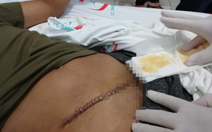 Hatay'da 15 yaşındaki Hüseyin'in karnı motorlu testereyle kesildi - Resim: 3