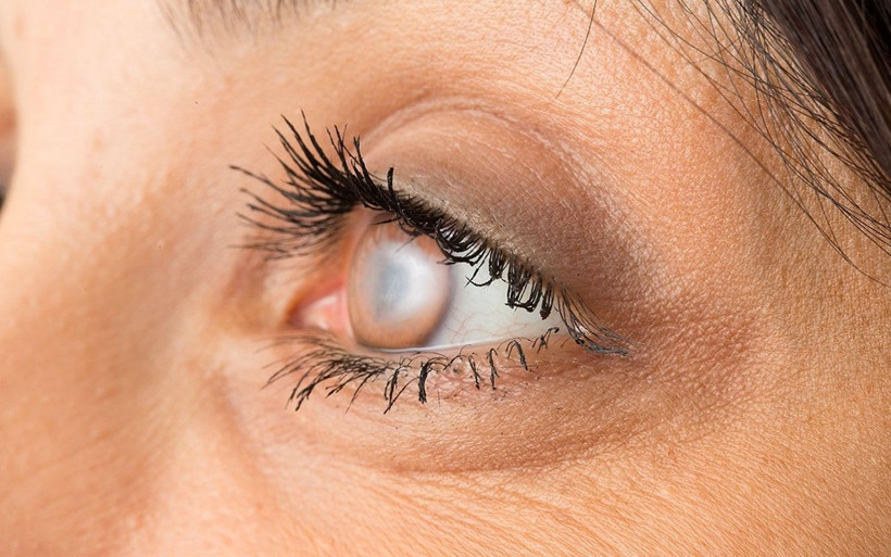 2020 yılında 40 milyon insan kör olacak uzmanlar yapılması gerekeni açıkladı - Resim: 4