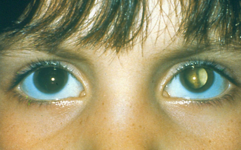 2020 yılında 40 milyon insan kör olacak uzmanlar yapılması gerekeni açıkladı - Resim: 3