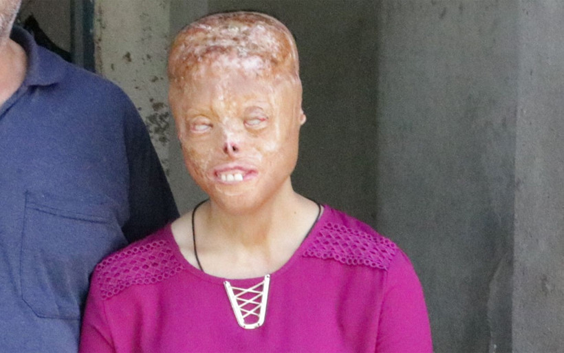 Başörtüsü yanınca bu hale geldi! Çocuklar korkuyor diye okula almıyorlar - Resim: 4