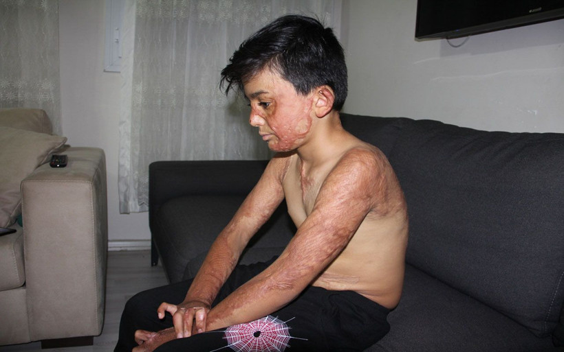 Vücudunun yüzde 50'si yanmıştı... Umut’un yardım çığlığı: Eski derimi istiyorum - Resim: 4