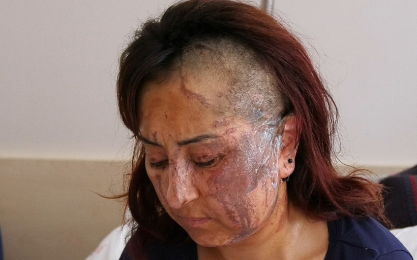 Isparta'da boşanmak isteyen eşe kezzaplı saldırı - Resim: 4