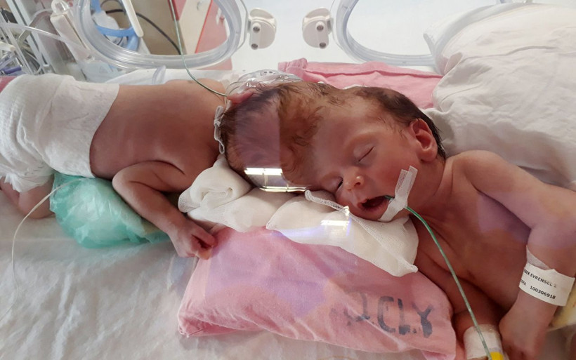 Antalya'da doğan yapışık ikizler İngiltere'de ayrıldı! Cumhurbaşkanı göndermişti - Resim: 2