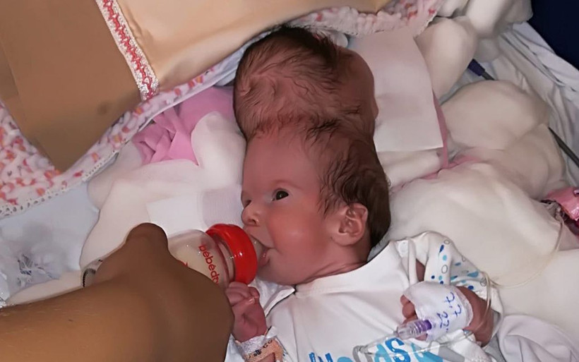 Antalya'da doğan yapışık ikizler İngiltere'de ayrıldı! Cumhurbaşkanı göndermişti - Resim: 1