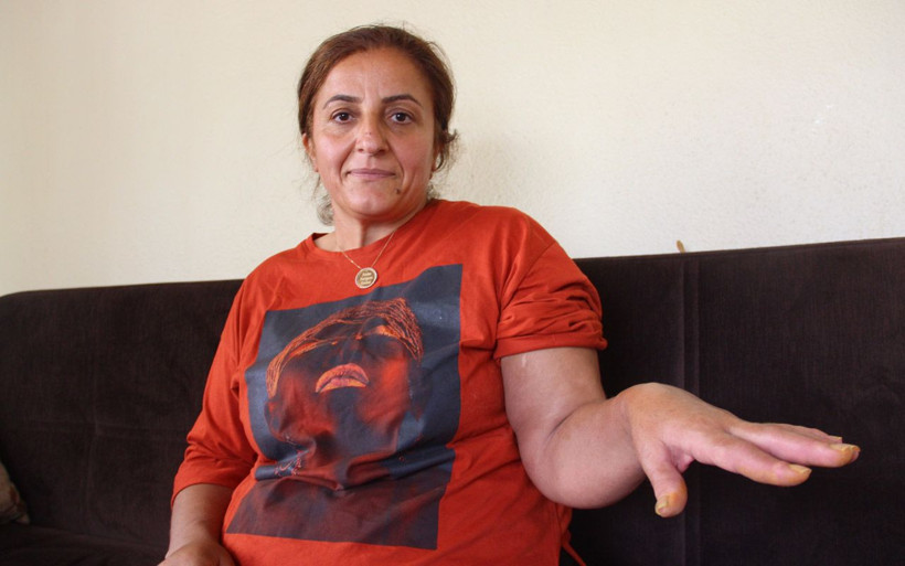 Sivas'ta bacağındaki keneyi kopardı yoğun bakımlık oldu - Resim: 2