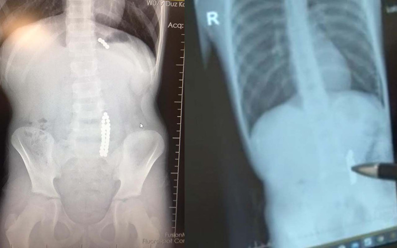 Karın ağrısıyla hastaneye götürdüler çocuğun midesinden çıkanlar hayret verici! - Resim: 1