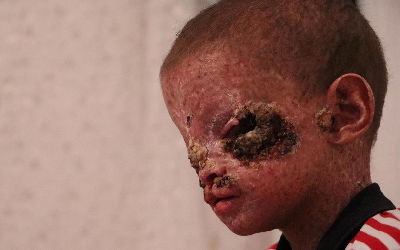 Erzurum'da cilt kanseri 8 yaşındaki Salih yardım bekliyor - Resim: 2