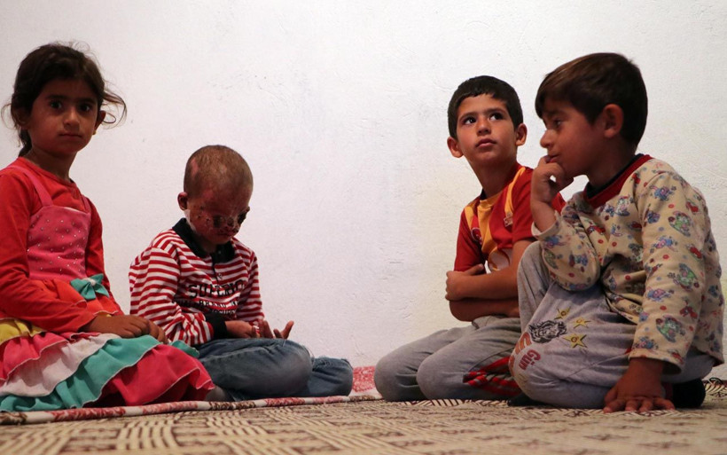 Erzurum'da cilt kanseri 8 yaşındaki Salih yardım bekliyor - Resim: 1