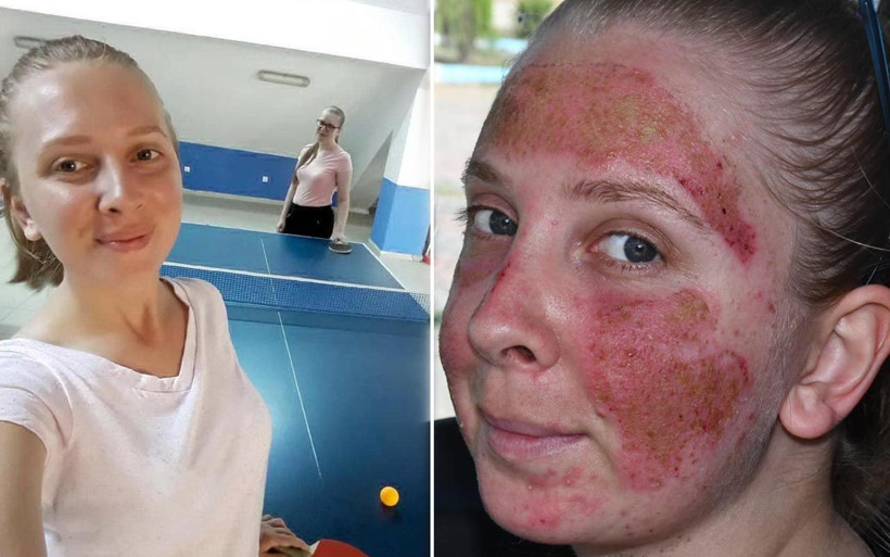 Tekirdağ'da cilt bakımı yaptıran Müge'nin yüzünde yanık oluştu 'Aynaya bakamıyorum' - Resim: 2