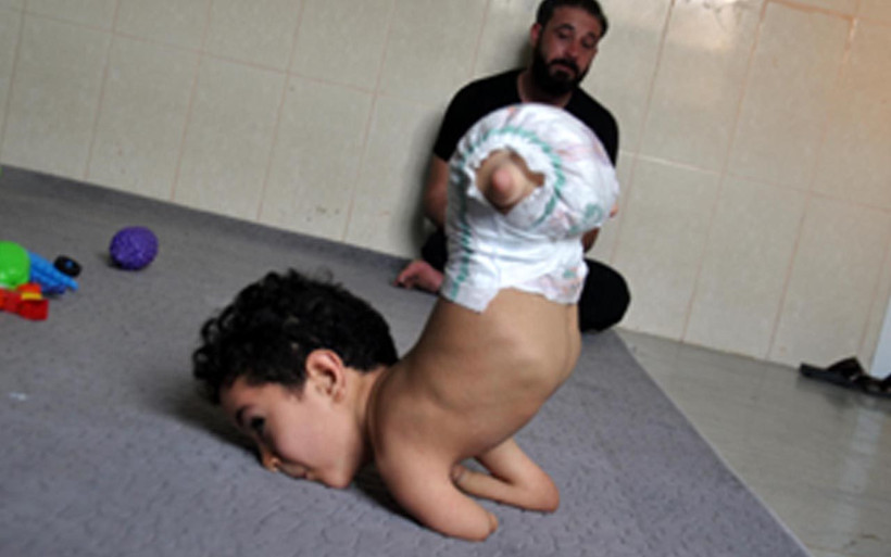 Hatay'da 2 bacağı ve 1 kolu olmayan minik Mustafa'nın tek bir isteği var - Resim: 4