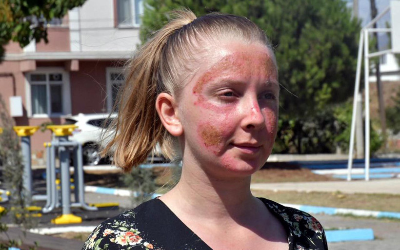 Tekirdağ'da cilt bakımı yaptıran Müge'nin yüzünde yanık oluştu 'Aynaya bakamıyorum' - Resim: 4