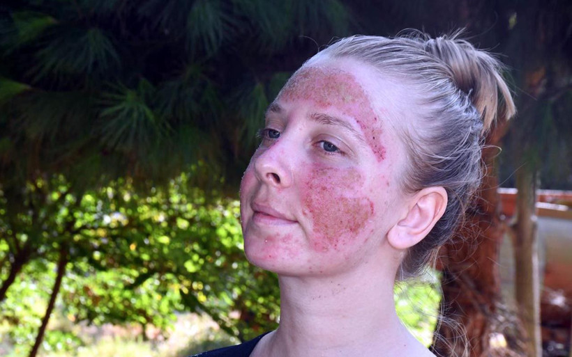 Tekirdağ'da cilt bakımı yaptıran Müge'nin yüzünde yanık oluştu 'Aynaya bakamıyorum' - Resim: 3