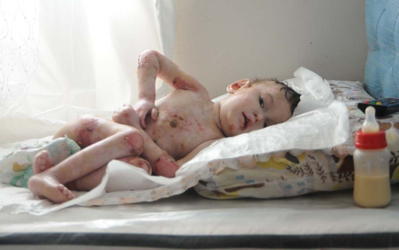 Görenin yüreği burkuluyor Şanlıurfa'da kelebek hastası Abdullatif için ailesi yardım istiyor - Resim: 1