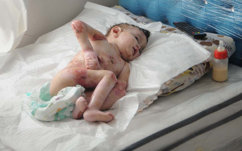 Görenin yüreği burkuluyor Şanlıurfa'da kelebek hastası Abdullatif için ailesi yardım istiyor - Resim: 3