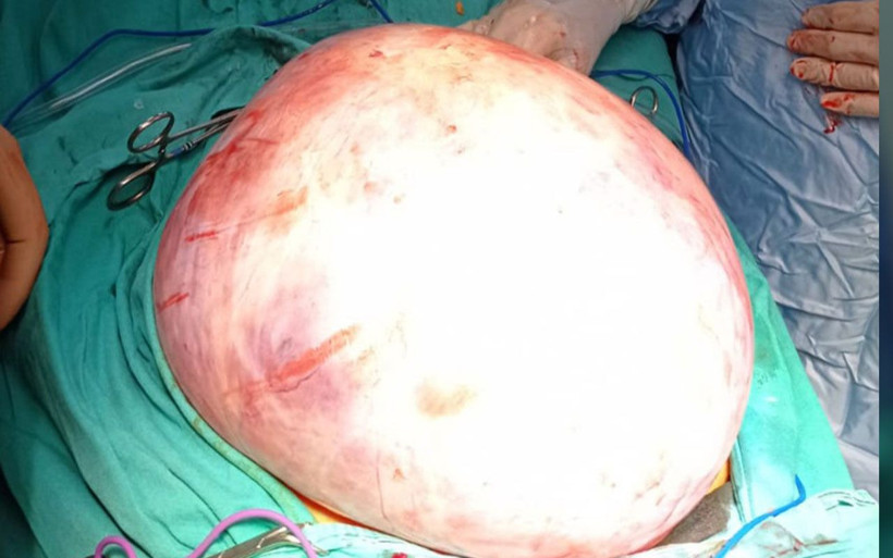 5 buçuk kilo ağırlığındaki tümör Niğde'de kadının karnından çıktı - Resim: 1
