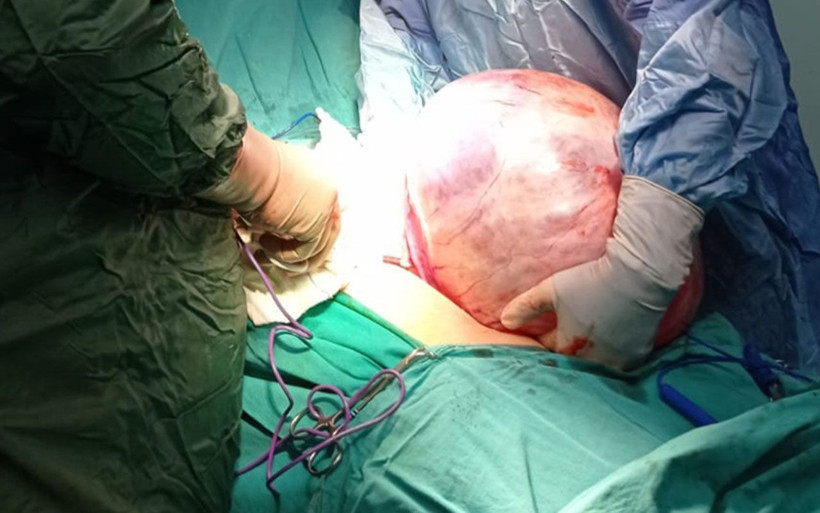 5 buçuk kilo ağırlığındaki tümör Niğde'de kadının karnından çıktı - Resim: 2