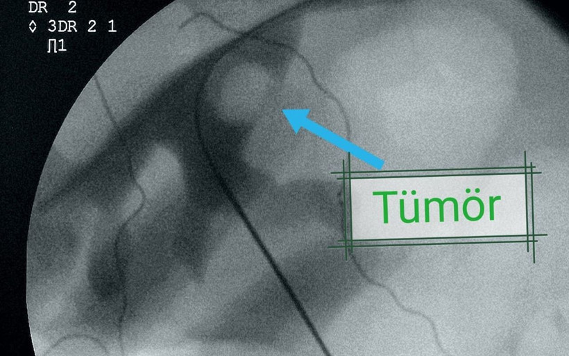 Dünya literatüründe 84’üncü vaka oldu Elazığ'da 'perkütan' yöntemi uygulandı - Resim: 3