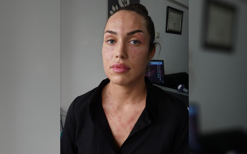 İzmir'de 'gençlik aşısı' hayatını kararttı 200 tane iğne vurdular bu hale geldi - Resim: 1