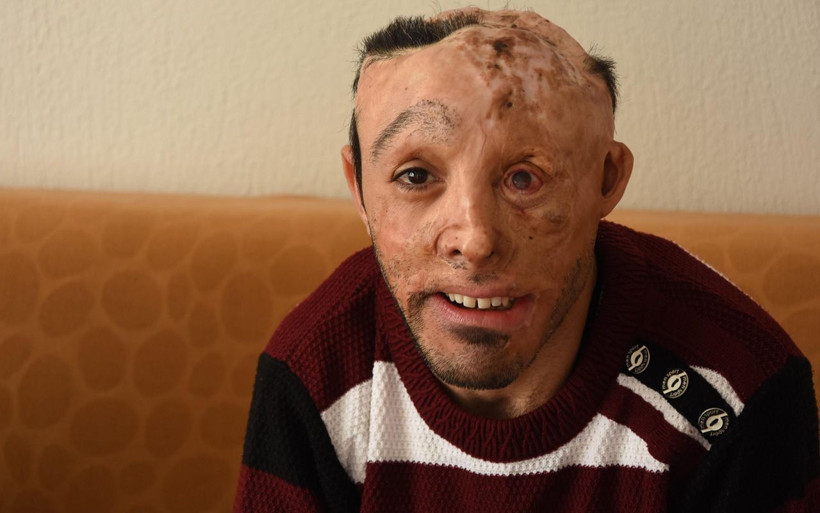 İzmir'de 6 aylık bebekken yandı belinden ve bacağından alınan dokular başına nakledildi - Resim: 1