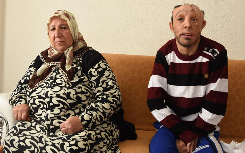 İzmir'de 6 aylık bebekken yandı belinden ve bacağından alınan dokular başına nakledildi - Resim: 2