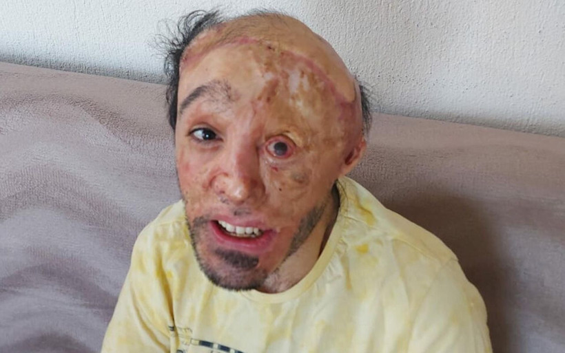 İzmir'de 6 aylık bebekken yandı belinden ve bacağından alınan dokular başına nakledildi - Resim: 3