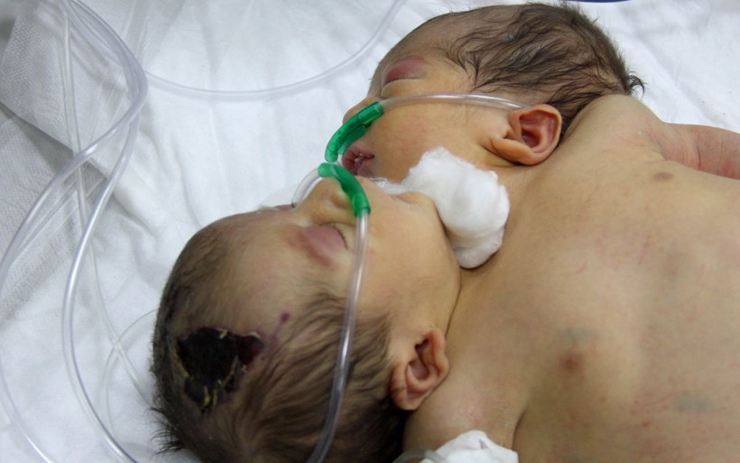 Siyam ikizleri Hatay'da tedavi altına alındı tek kalple yaşama tutunuyorlar! - Resim: 2