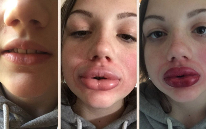 Estetik yaptıranlar ABD'nin korona aşısını olmasın! Dolgusu olanda iltihap yapıyor - Resim: 4